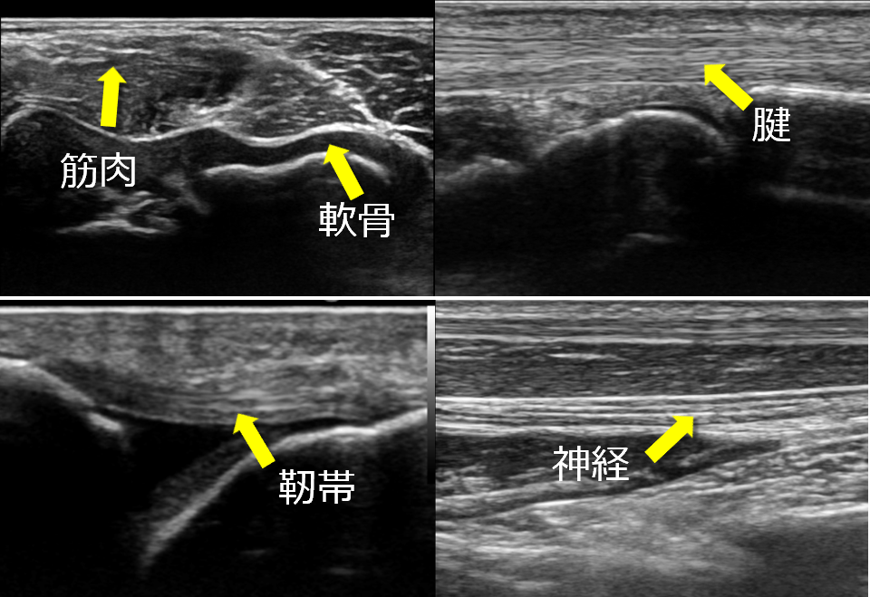 超音波検査 写真
