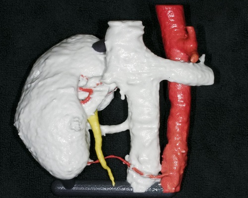手術支援立体模型（腎臓）