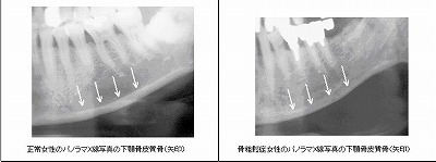 下顎皮質骨のパノラマｘ線写真(左：正常，右：骨粗鬆症)