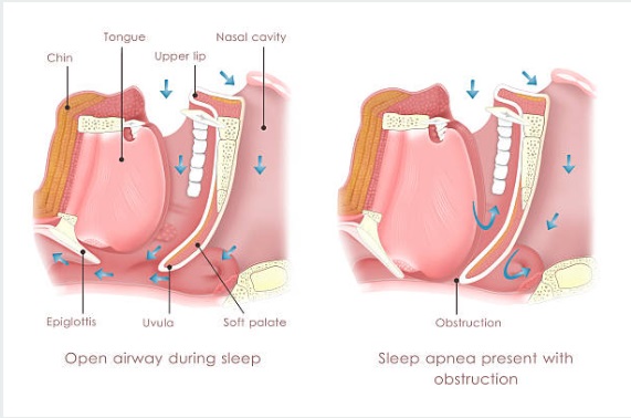 Clear and blocked airway during sleep.