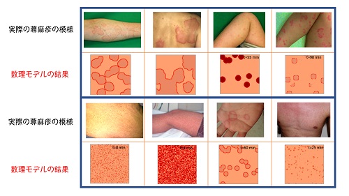 蕁麻疹で見られる多様な幾何学的形態と数理モデルにより再現された膨疹の形態
