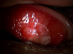 図２：シールド潰瘍と呼ばれる角膜の傷