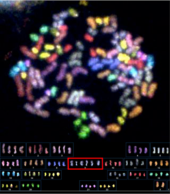 図１．PCS症候群患児のリンパ球の染色体マルチカラーFISH画像