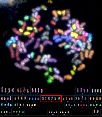 図1.PCS症候群患児のリンパ球の染色体マルチカラーFISH画像