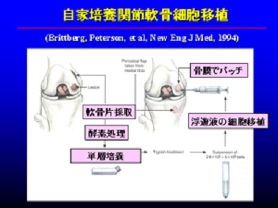 浮遊液注入方式の培養軟骨細胞移植の流れ図