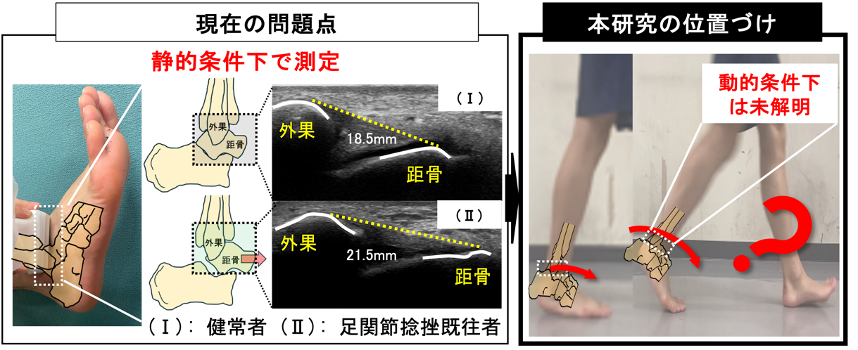 研究成果】足関節捻挫癖を発症した患者の歩行時の骨の動きを解明