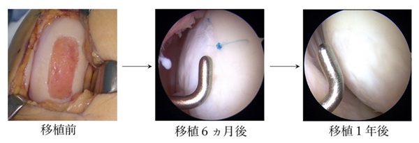 変形性膝関節症に対する「ジャック」移植後の軟骨の修復経過