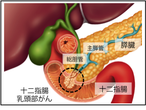 十二指腸乳頭部がんイラスト