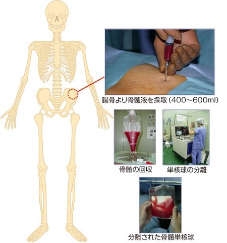 自家骨骨髄細胞移植（骨髄採取の流れ図）