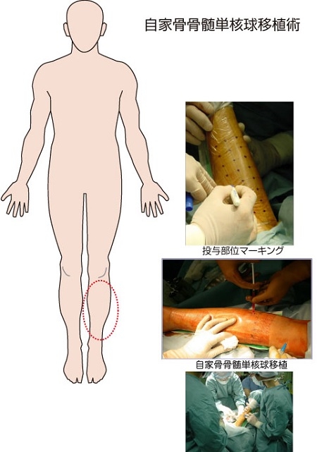 自家骨骨髄細胞移植（移植に関する図）