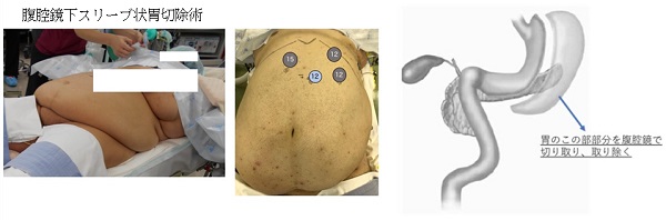腹腔鏡下スリーブ状胃切除術
