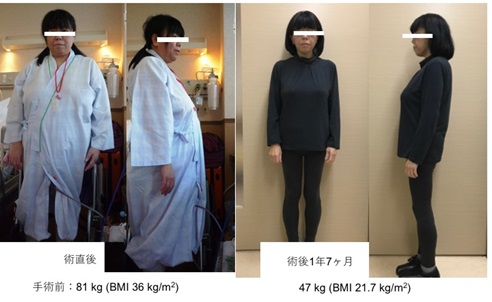 腹腔鏡下スリーブ状胃切除術