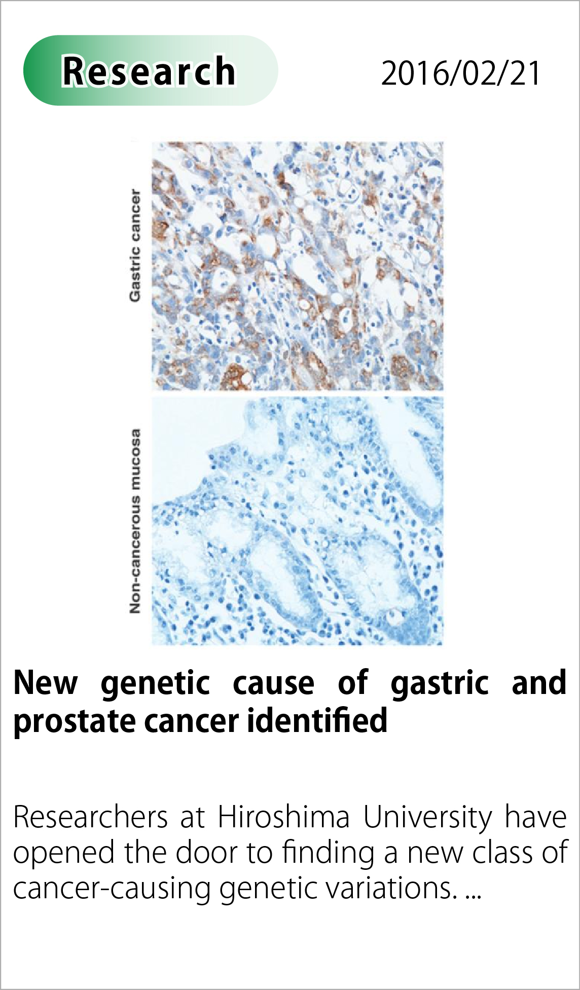 New genetic cause of gastric and prostate cancer identified