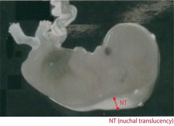 出生前診断NT (nuchal translucency) の画像