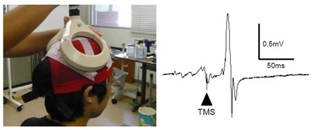 経頭蓋磁気刺激と前脛骨筋から記録した運動誘発電位の波形例